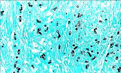 Grocott-Gomori’s Methenamine Silver Stain (GMS)