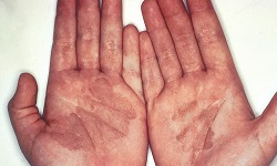 Clinical classification of Mycosis