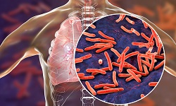 Tuberculosis