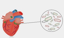 Infective endocarditis